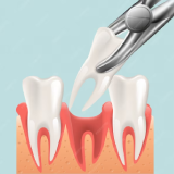 Composite Restorations